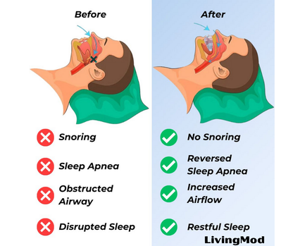 SnoreGuard™ Mouthpiece